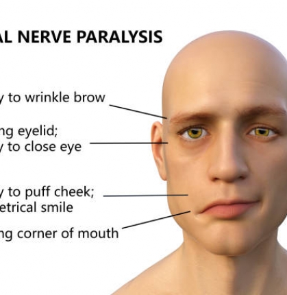 Myasthenia Gravis disease